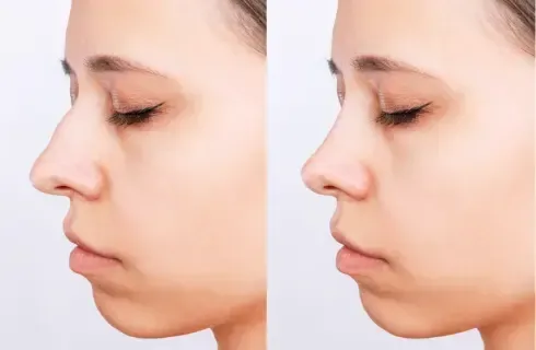 Victoria James's before and after simulation