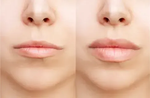 Elena Geller's before and after simulation