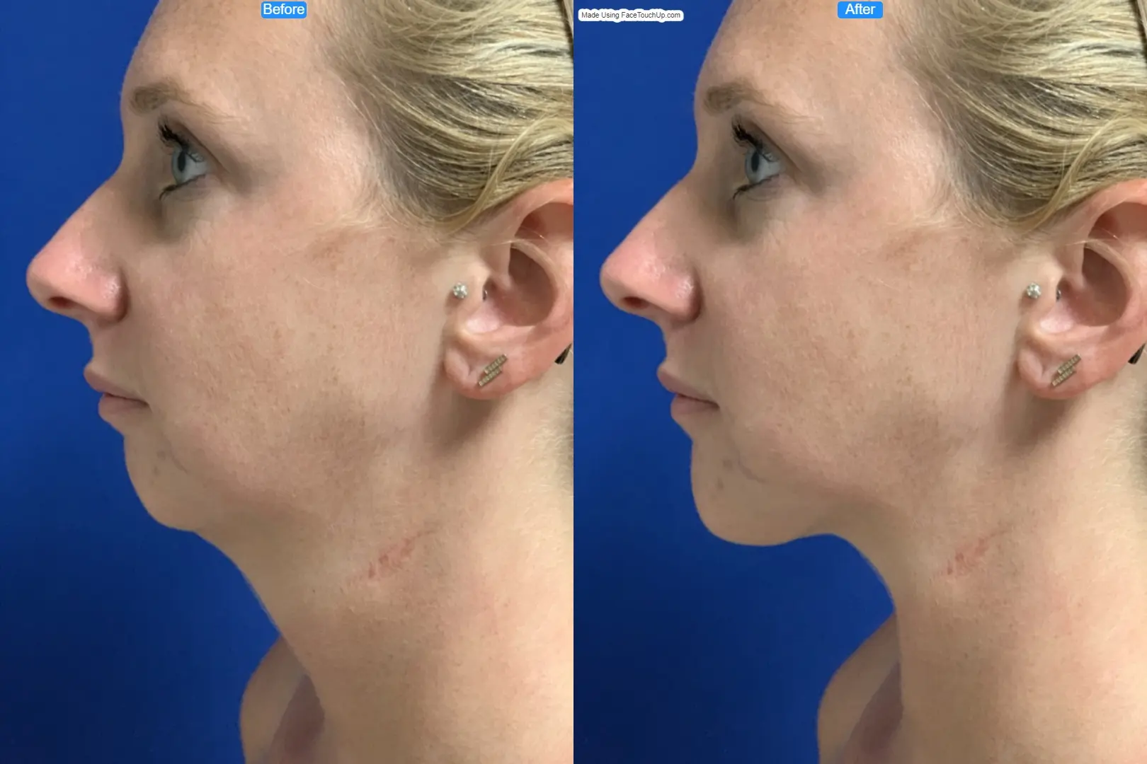 FaceTouchUp before and after plastic surgery simulation result